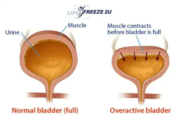 diagram of overactive bladder treatment West Midlands