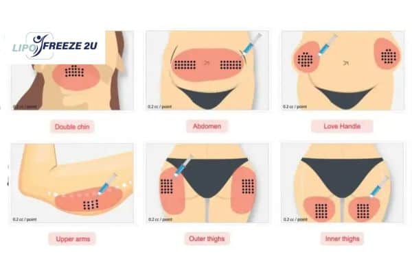 Benefits of Choosing Aqualyx for Fat Reduction West Midlands