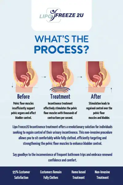 Diagram of how incontinence treatment West Midlands works.