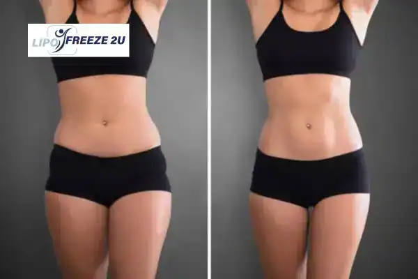 How Can LIPO FREEZE 2U Support Your Post-Pregnancy Body Recovery West Midlands?