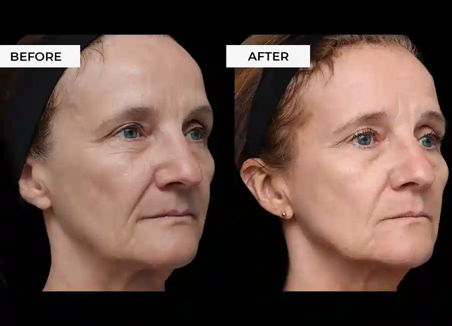 How Many RF Microneedling Sessions Will You Need to See a Difference West Midlands?