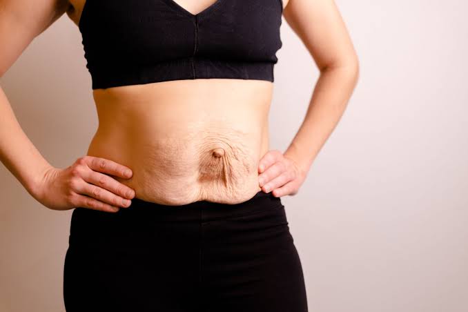Is Surgery Really the Only Way to Repair Diastasis Recti West Midlands?